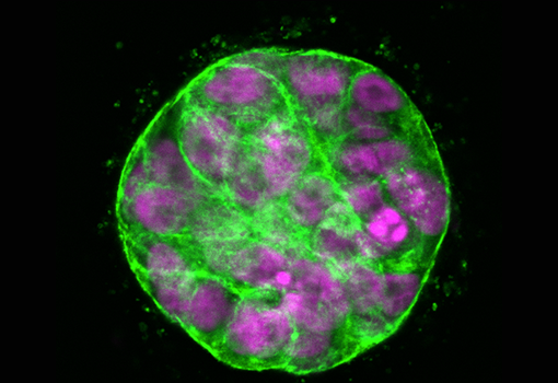 A spheroid of mammary epithelial cells encapsulated in a 3D hydrogel simulating the tumor microenvironment. 