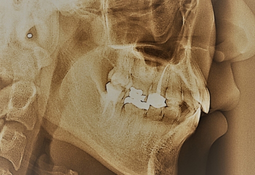 Teeth X-Ray