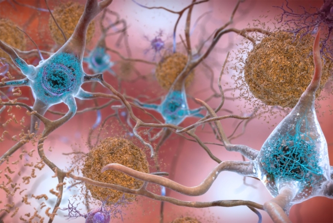 In patients with Alzheimer's disease, tau proteins (shown in light blue) misfold and accumulate inside brain cells. By making a synthetic version of these proteins, researchers aim to better understand disease.